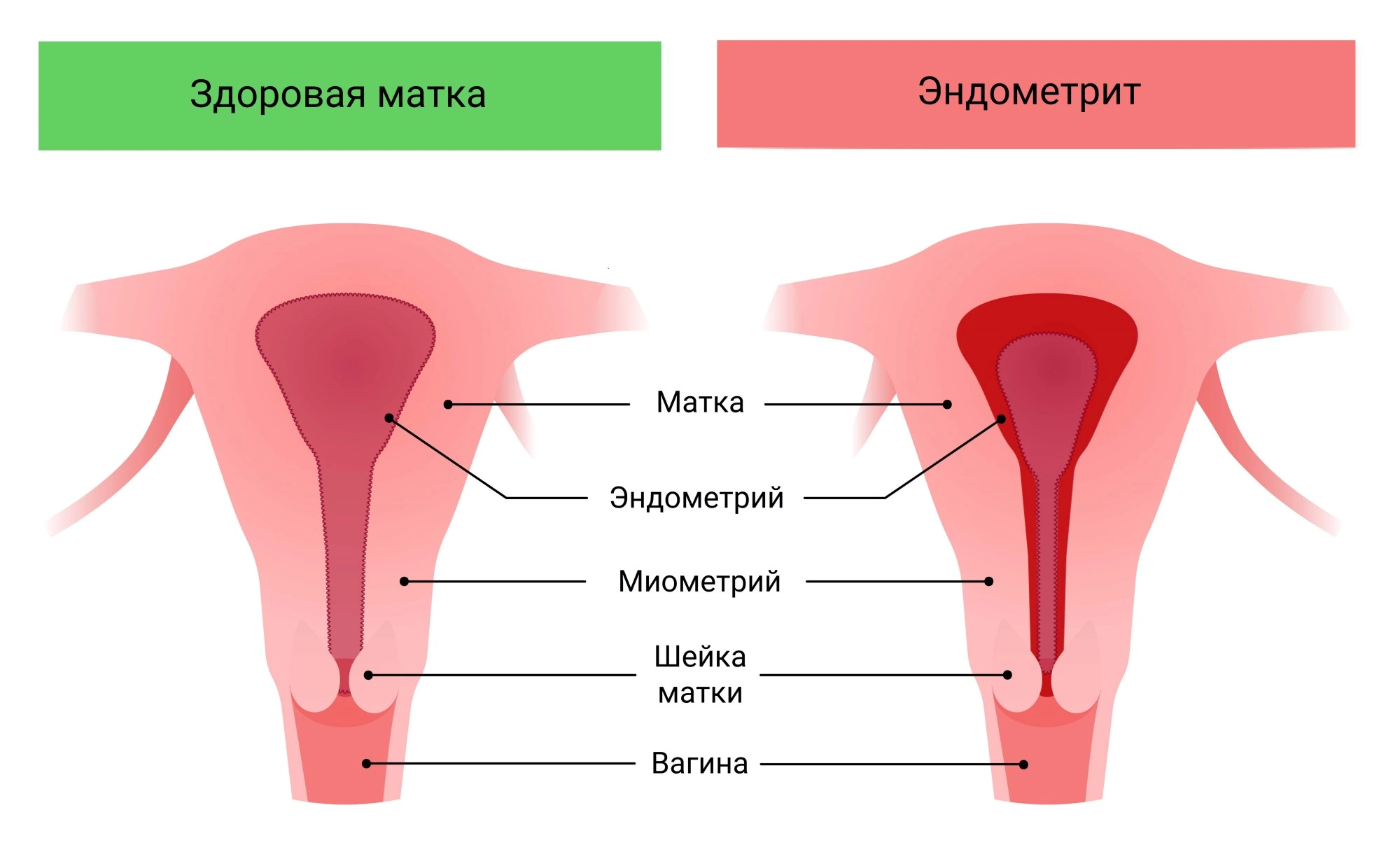Эндометрит: симптомы и лечение у женщин - признаки и причины эндометрита  матки