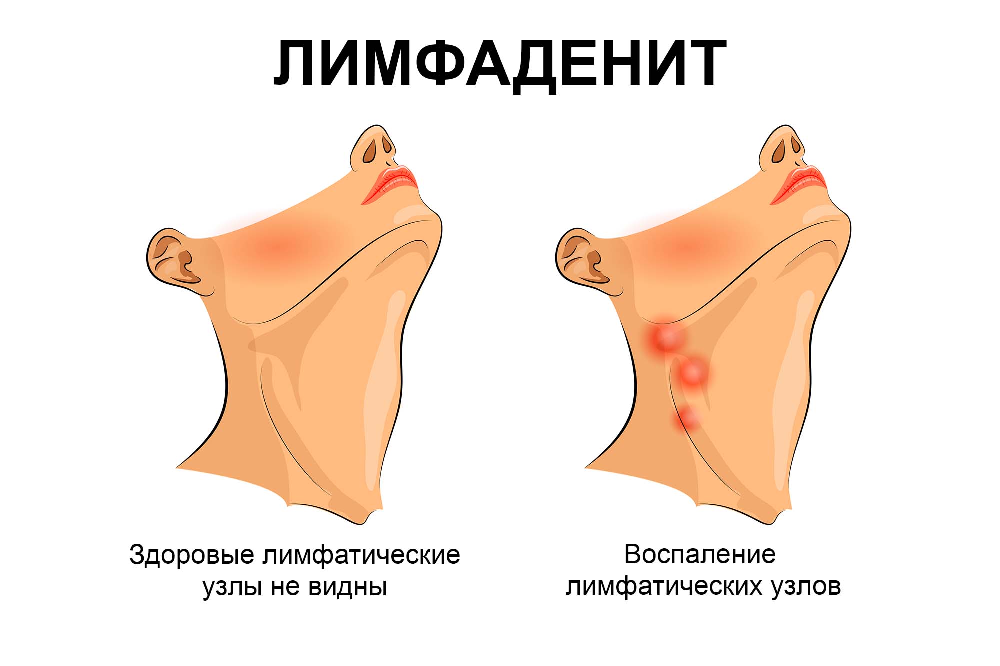 Лимфаденит