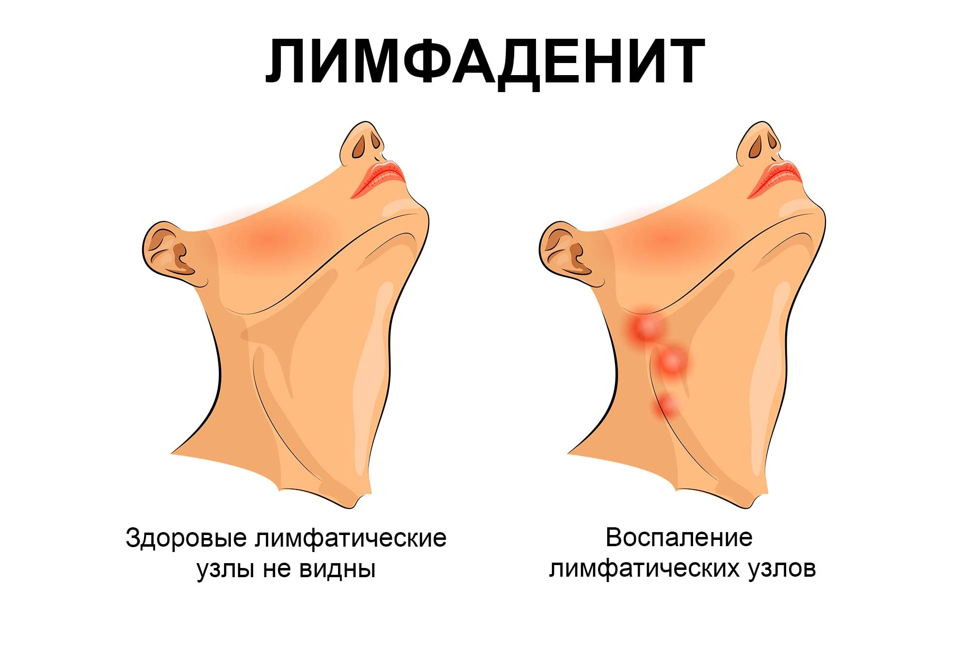 Почему увеличиваются лимфоузлы на шее: причины и методы лечения