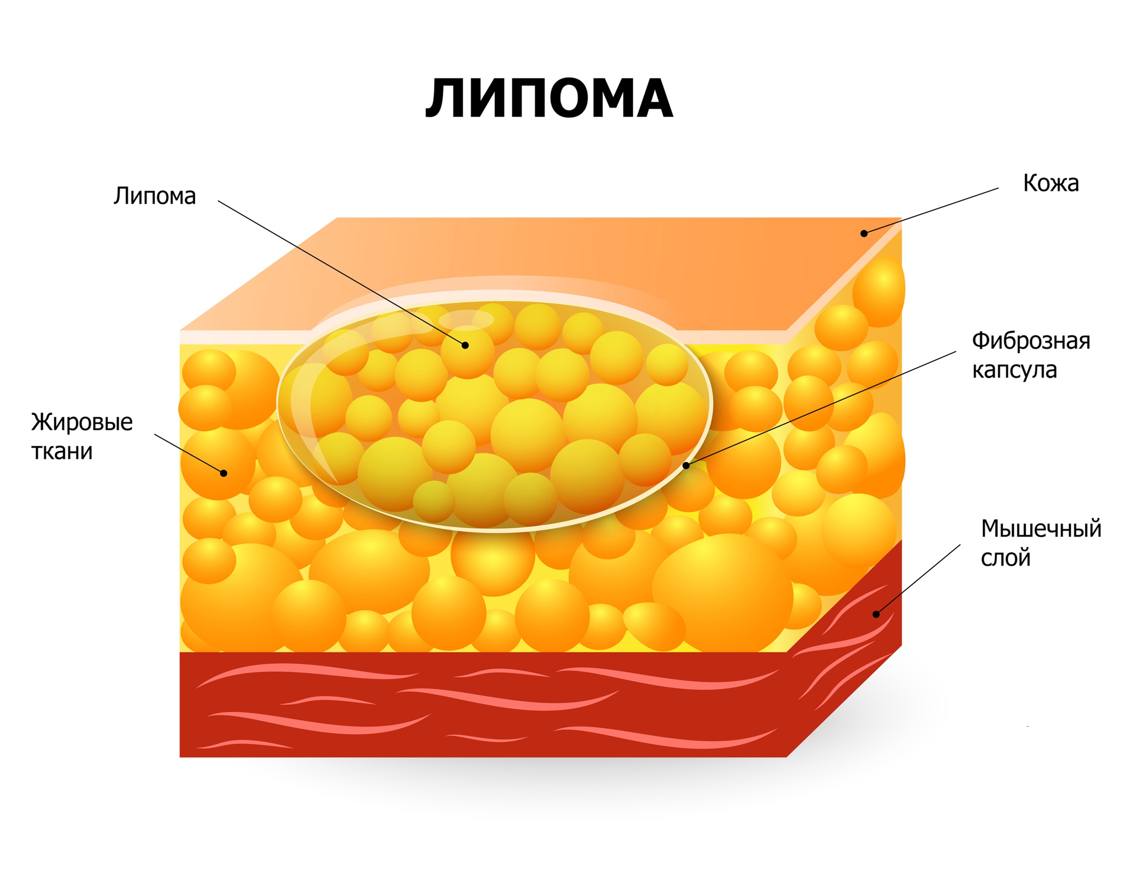 Липома жировик