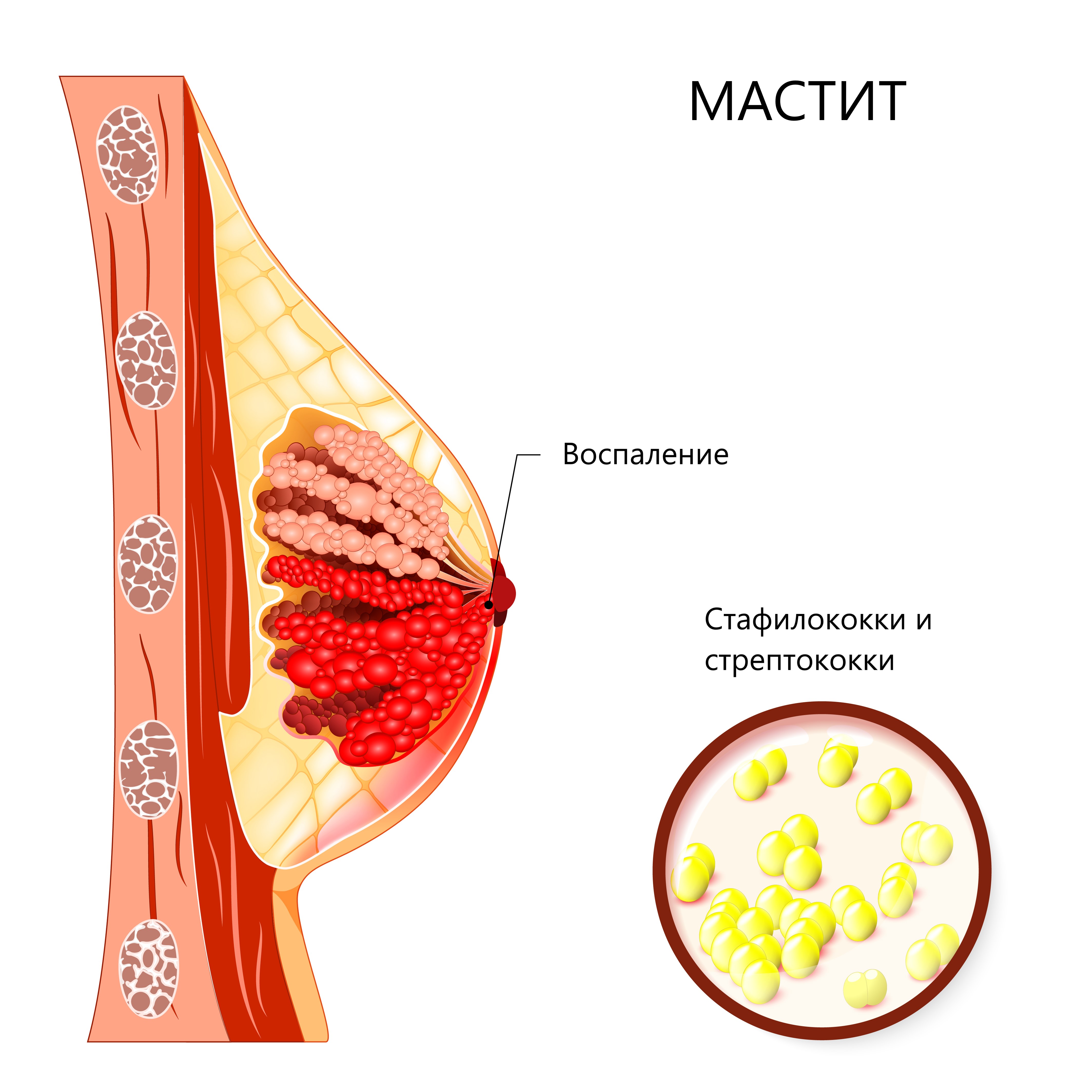 Мастит