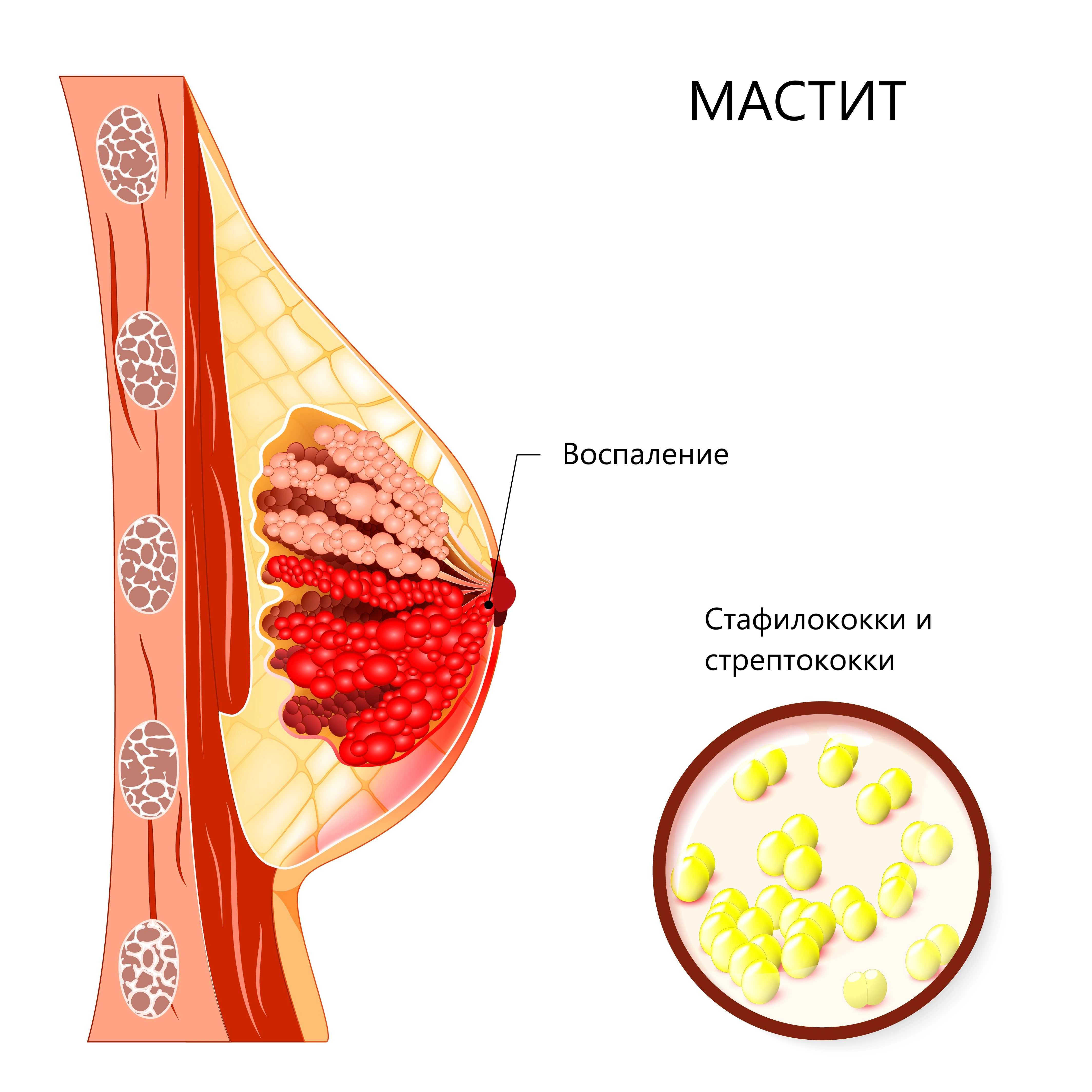 Мастит - что это такое, симптомы, лечение, профилактика