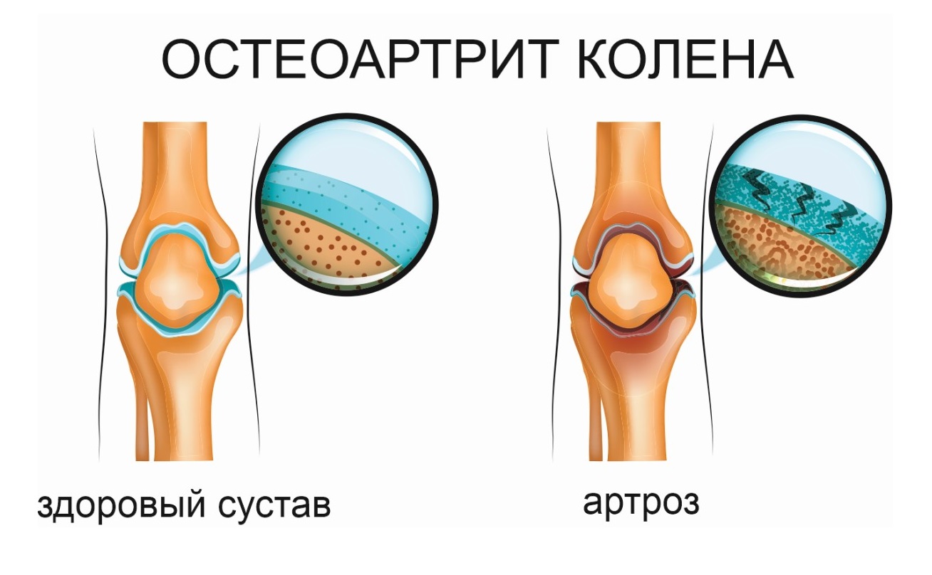 Остеоартрит