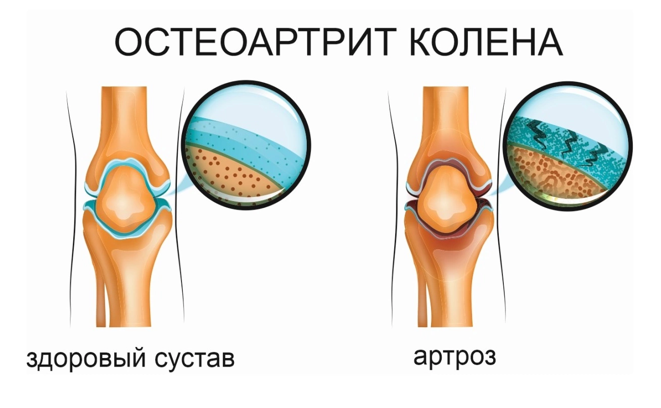 Чем остеоартроз отличается от артрита. Чем отличается артрит от артроза? Рассказывает ортопед-травматолог. Чем отличается артрит от артроза коленного или тазобедренного сустава. Чем отличается артроз от артрита