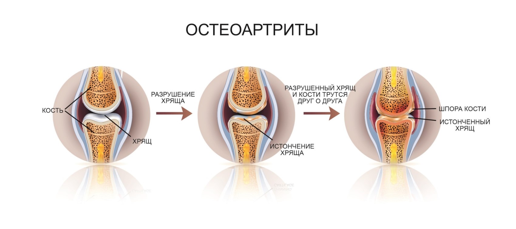 Остеоартрит