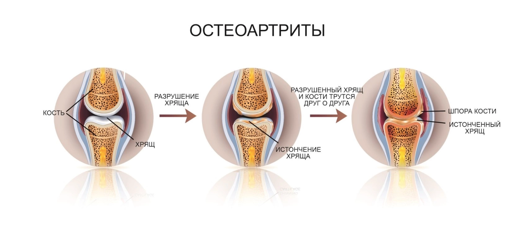 Ограничение подвижности в суставах