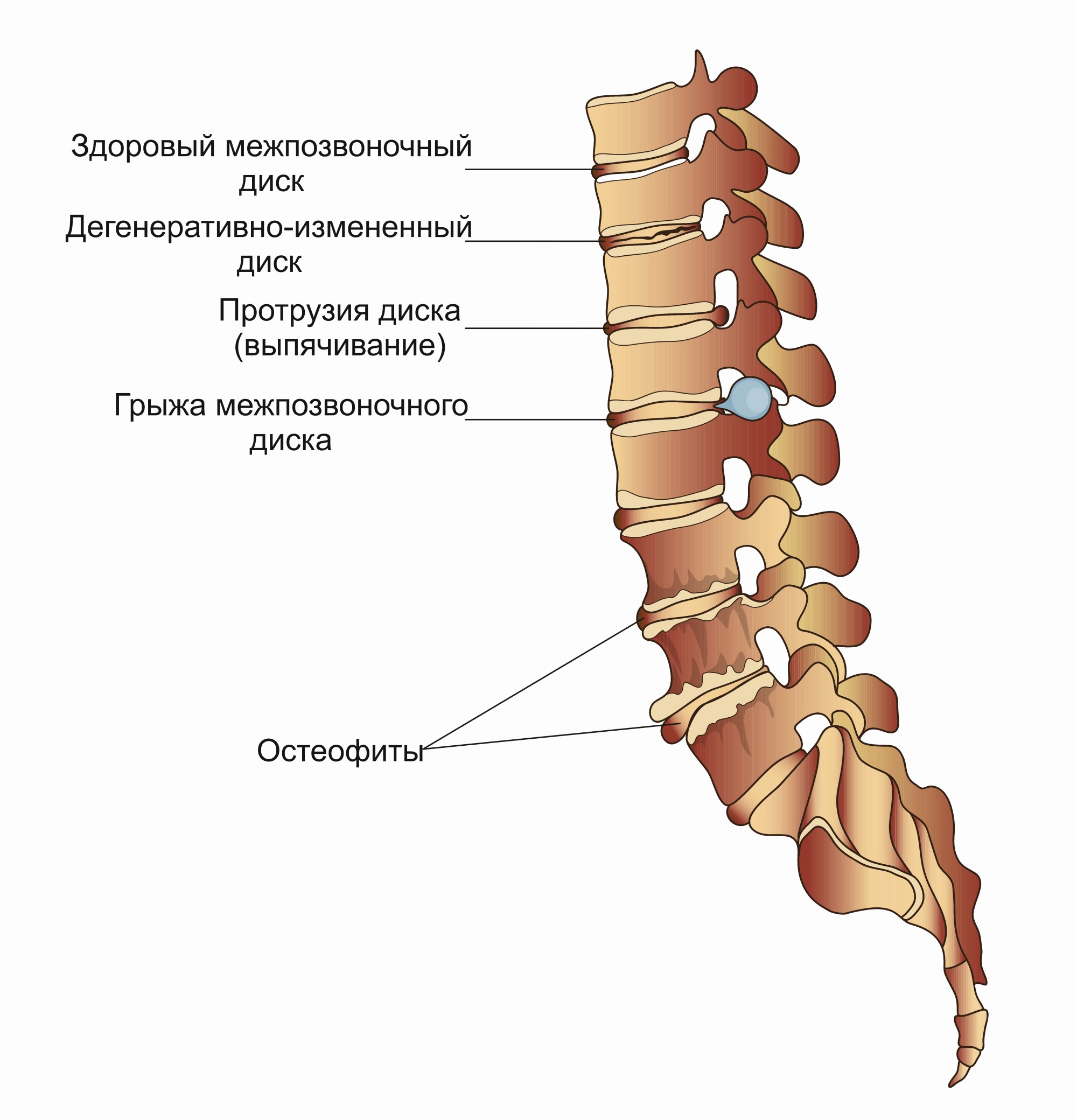 Остеофиты