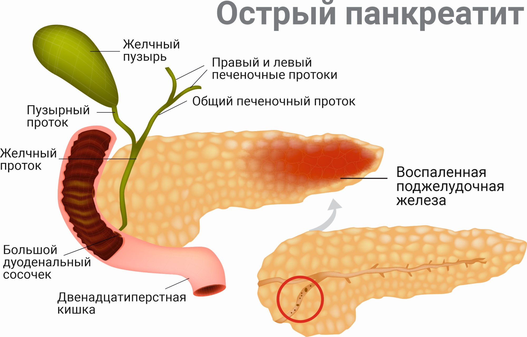 Вода в поджелудочной железе