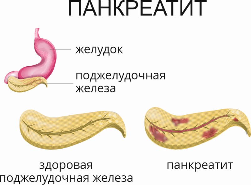 Панкреатит