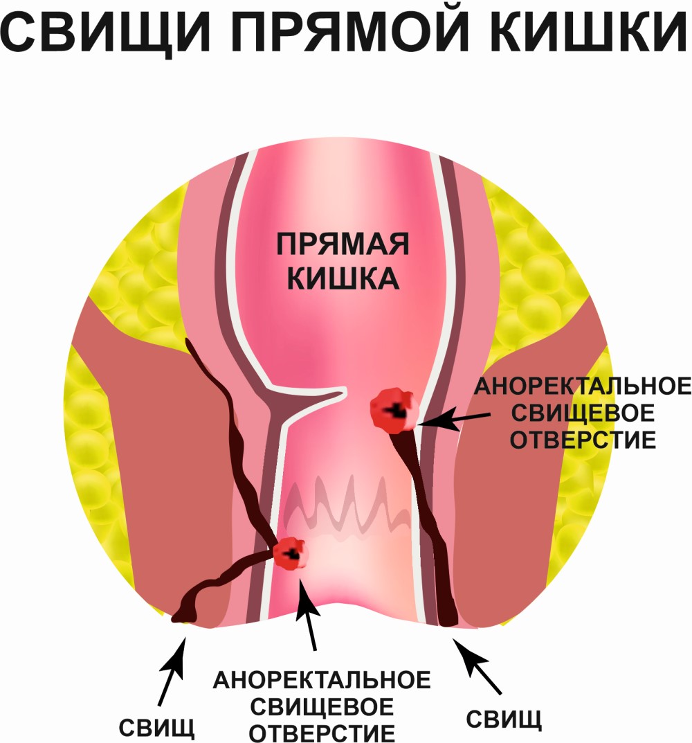 Свищ прямой кишки (хронический парапроктит)