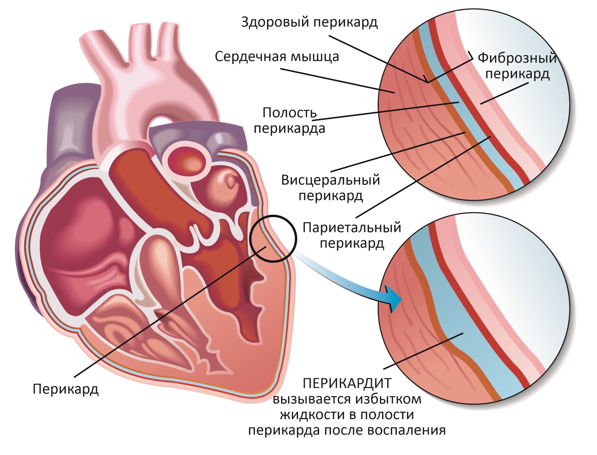 Перикардит