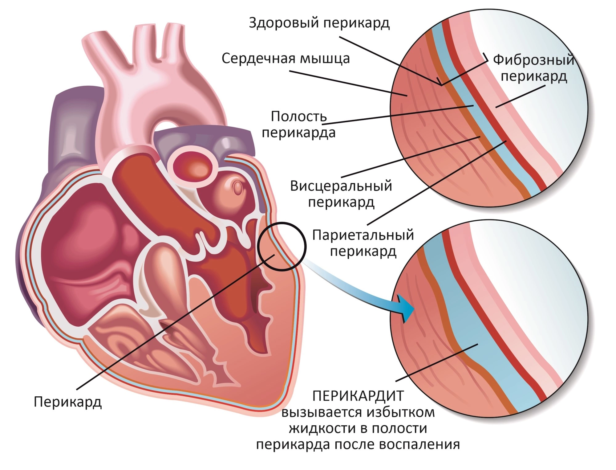 Перикардит сердца - симптомы, что это, клинические рекомендации, лечение