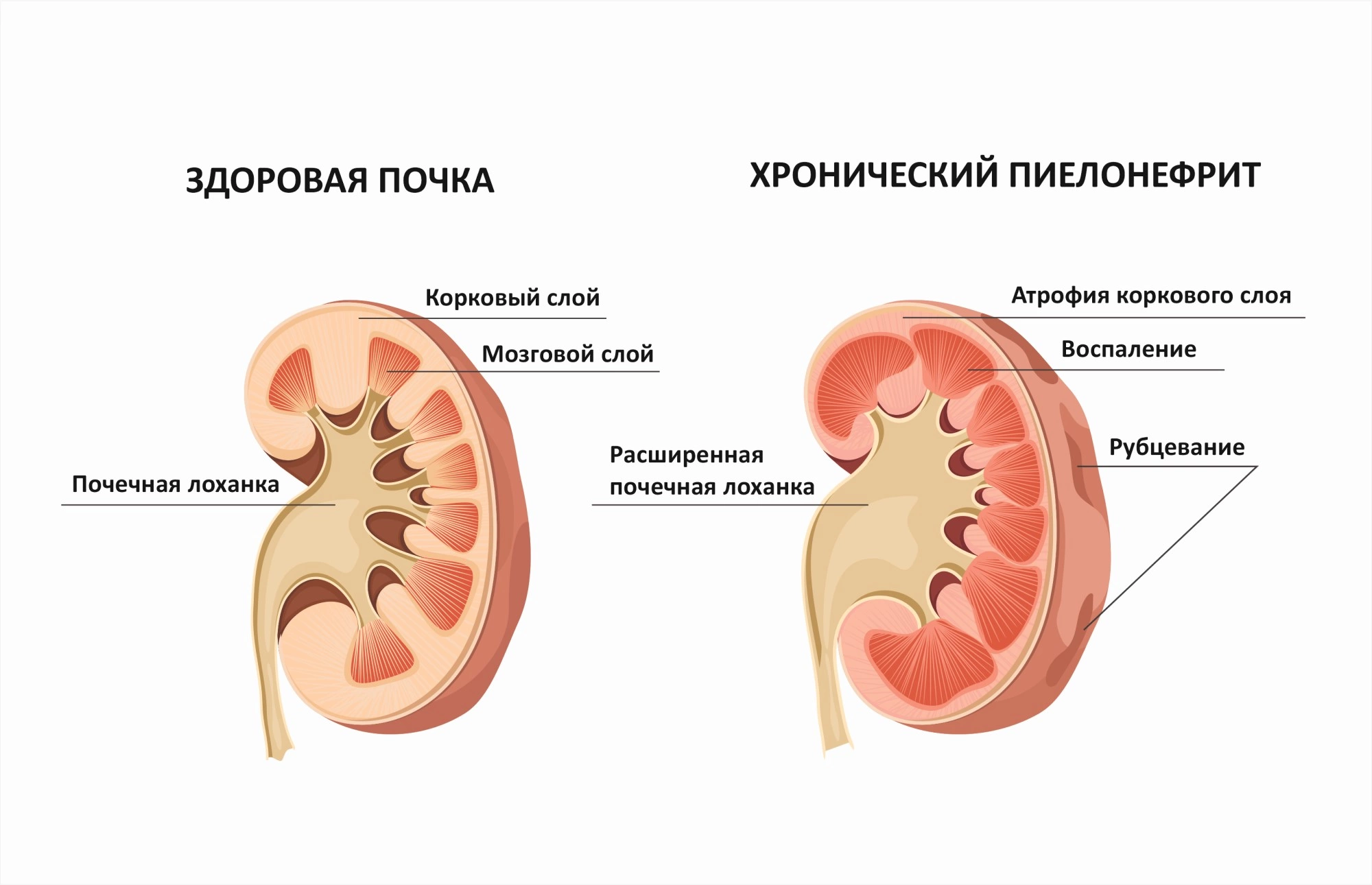 Полионефрит. Хронический пиелонефрит строение почек. Здоровая почка и хронический пиелонефрит. Хронический обструктивный пиелонефрит 11.1. Острый пиелонефрит почек симптомы.