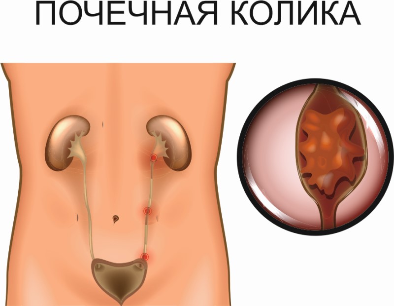 Почечная колика