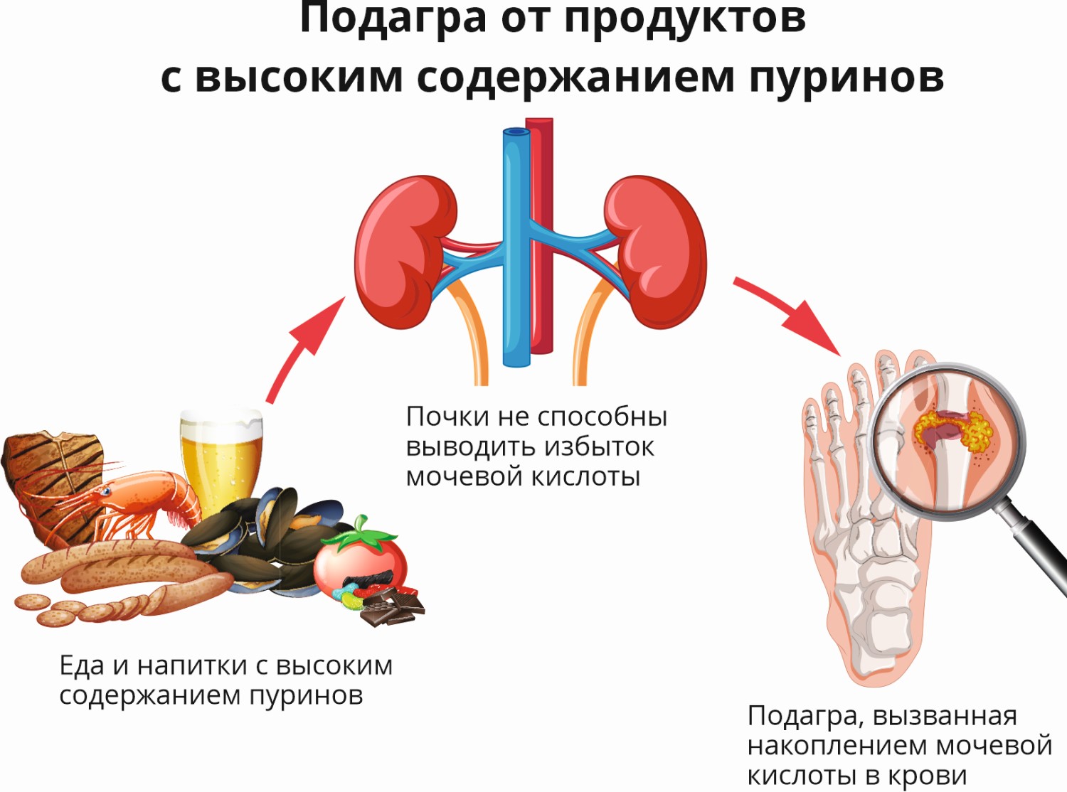 Подагра