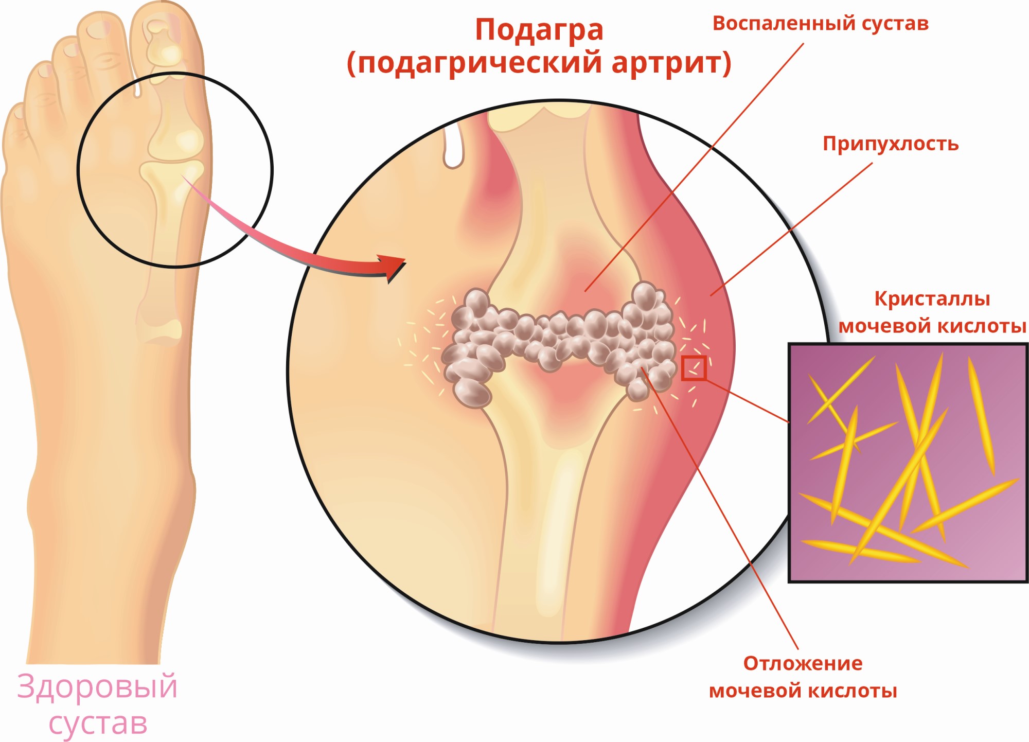 Подагра