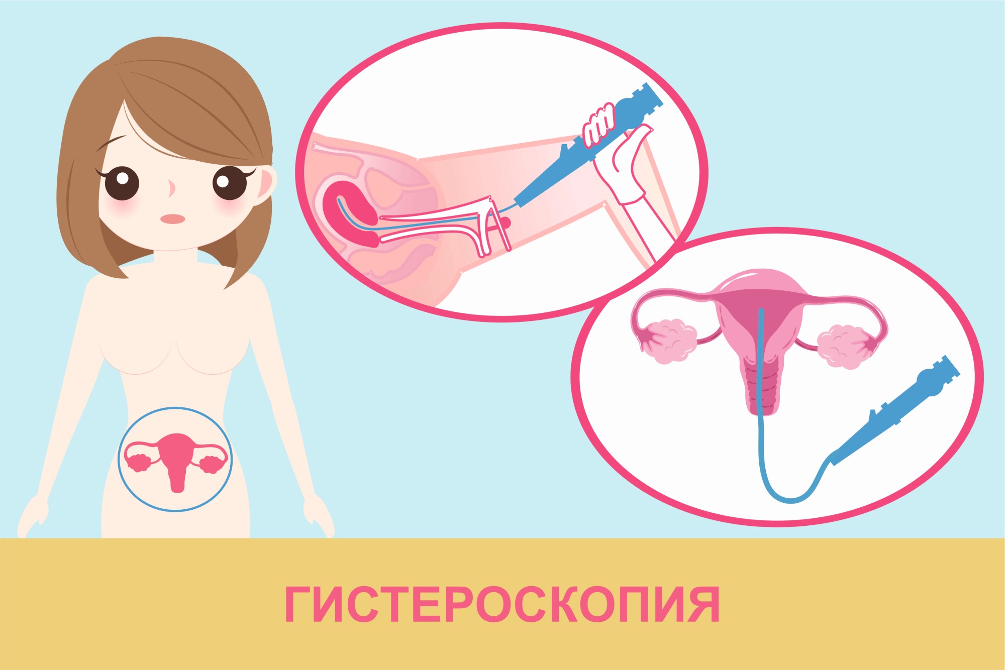 Полип эндометрия в матке