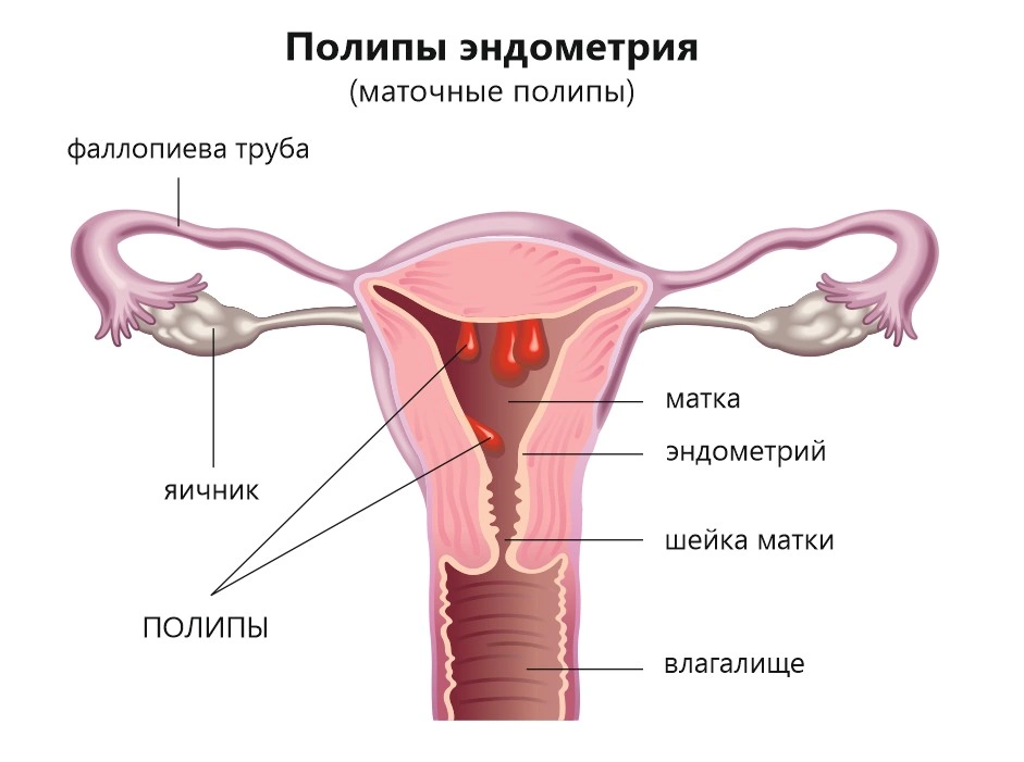 Полип эндометрия в матке - лечение, как удаляют, симптомы, чем опасен,  причины