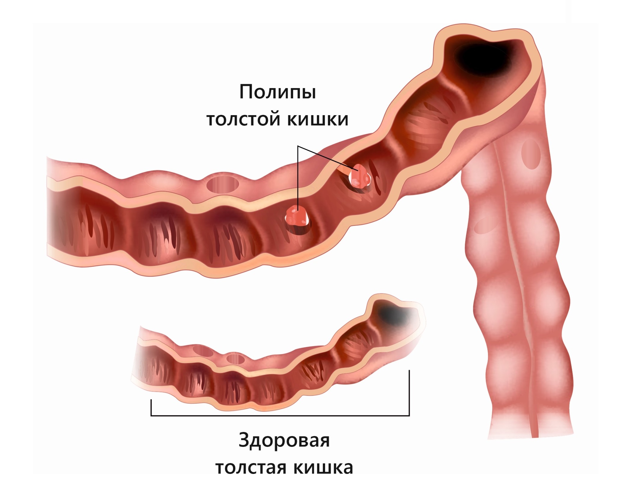 Разрыв толстой кишки картинки