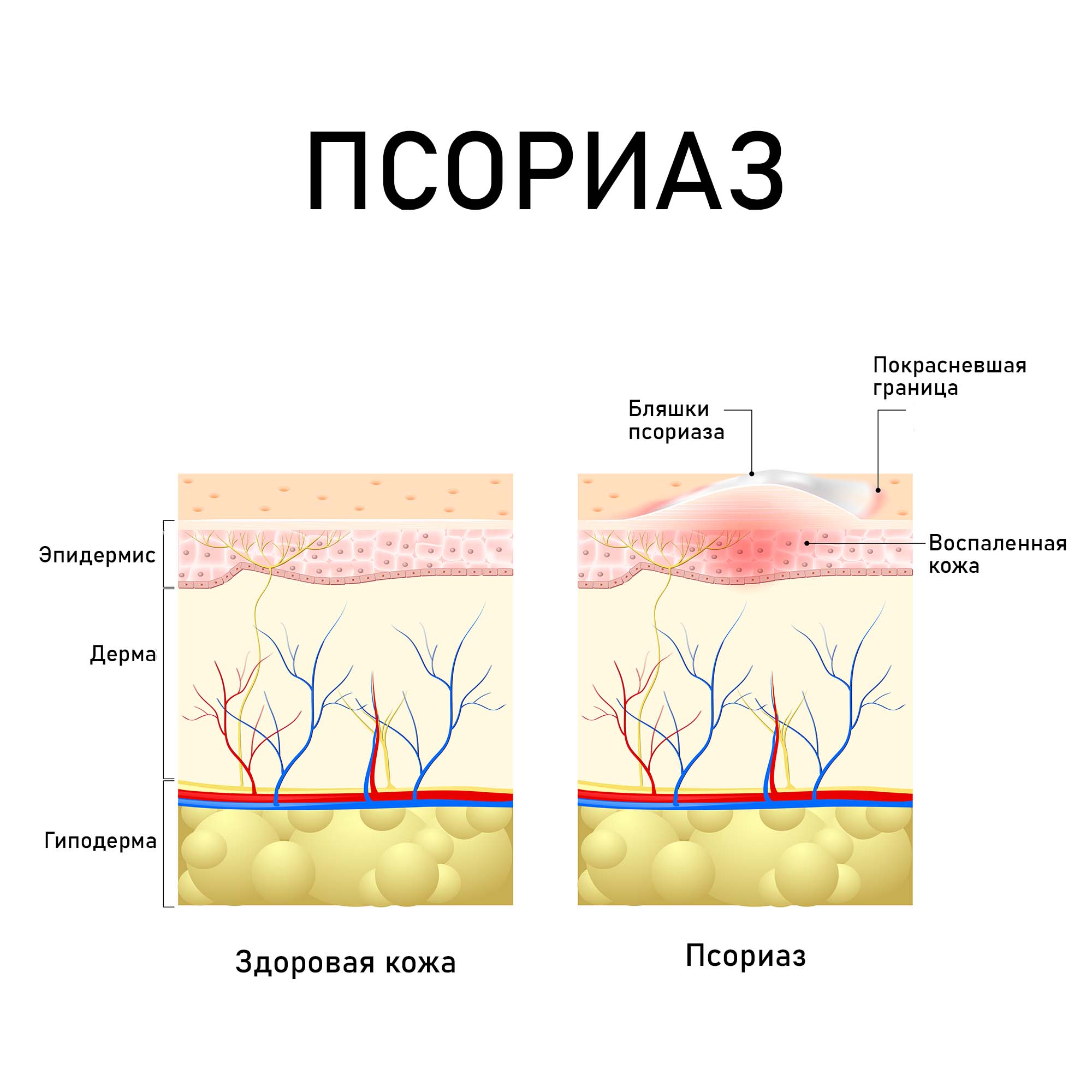 Половой псориаз у женщин и мужчин