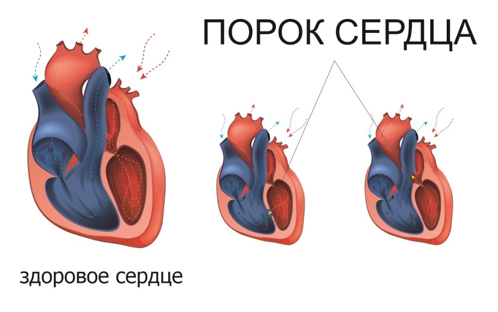 Порок сердца