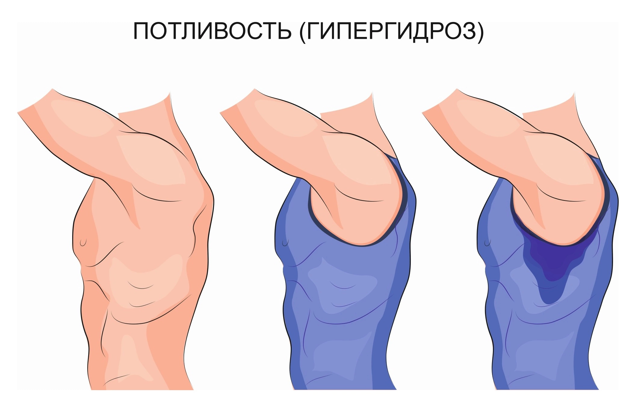 Причины чрезмерного потоотделения у человека