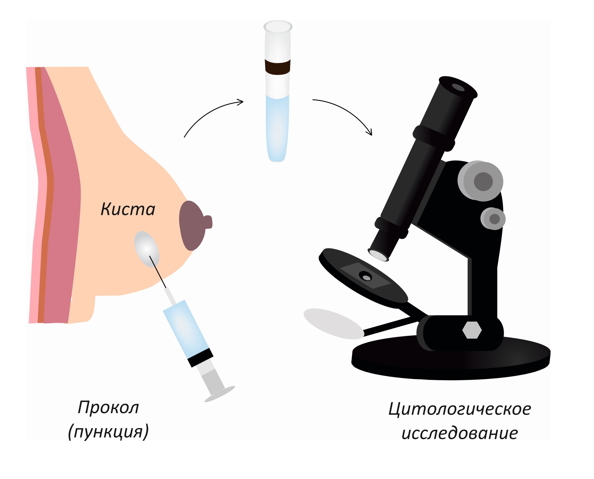 Пункция (биопсия) молочной железы