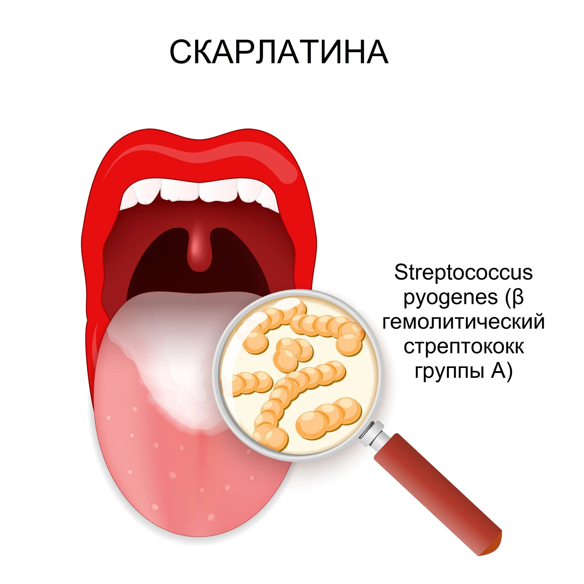 Скарлатина у взрослых: признаки, симптомы, диагностика, как передается, лечение