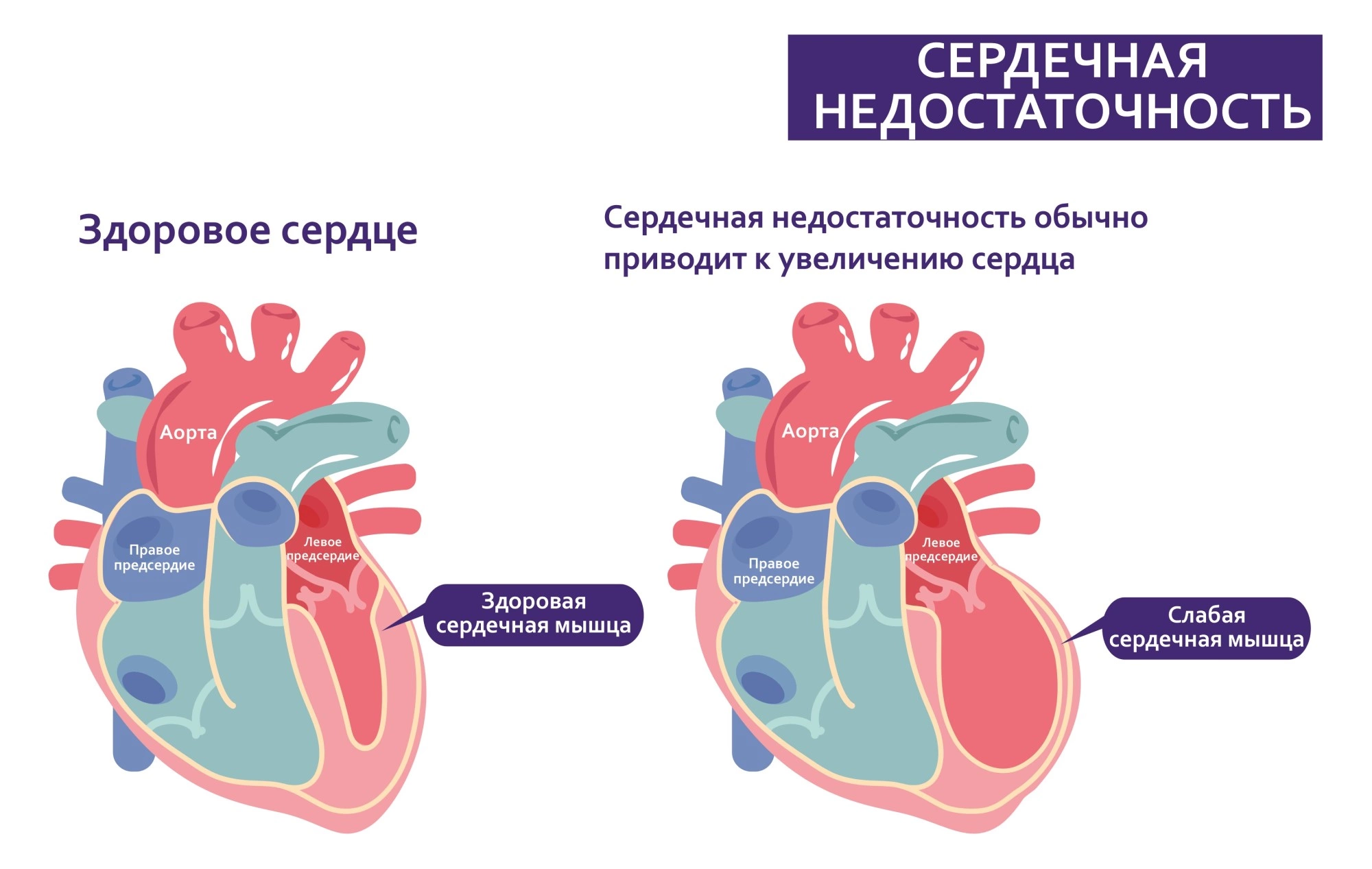 Сердечная недостаточность - симптомы, что это такое, как понять что она у  тебя, признаки