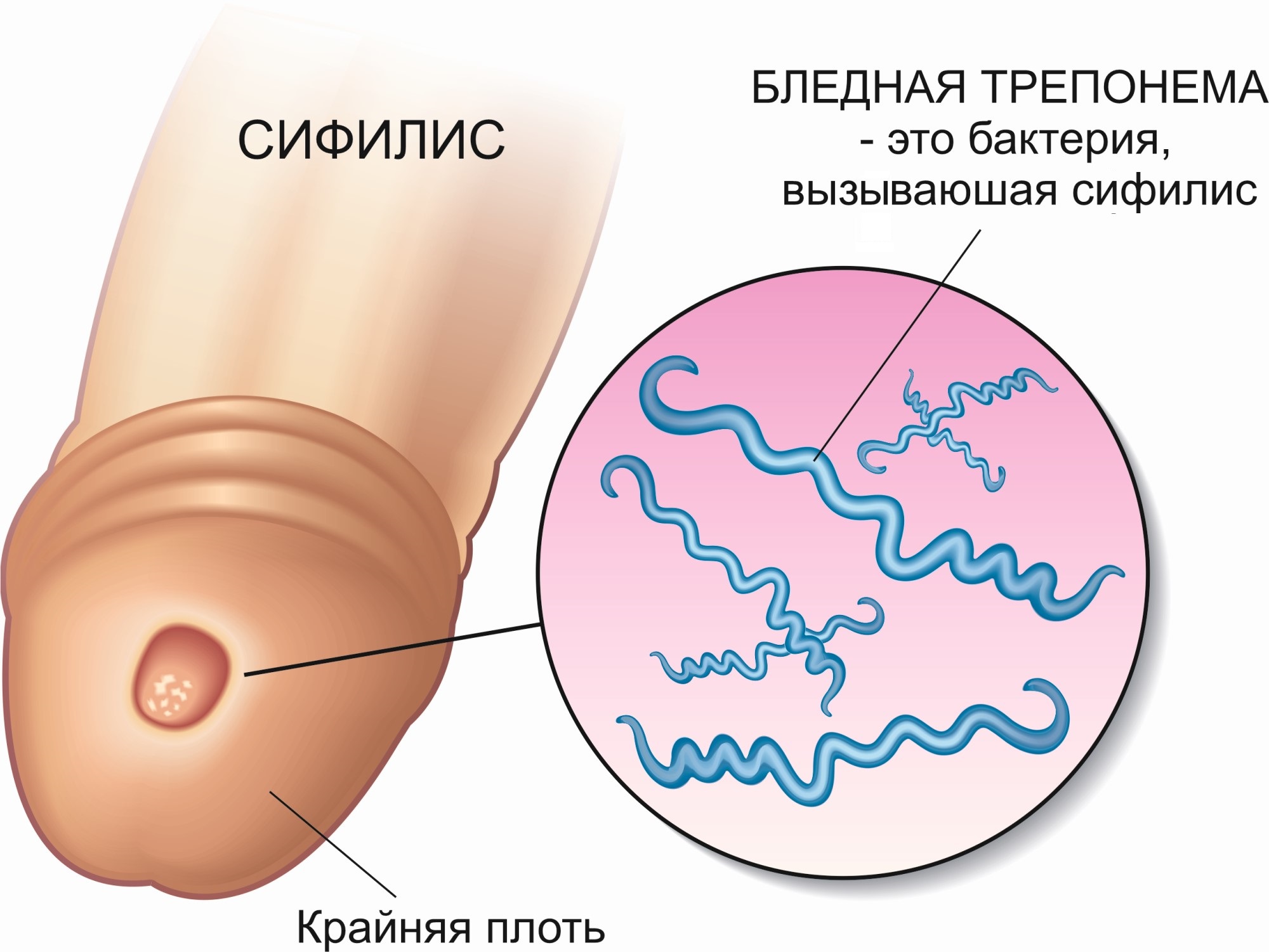 Сифилис