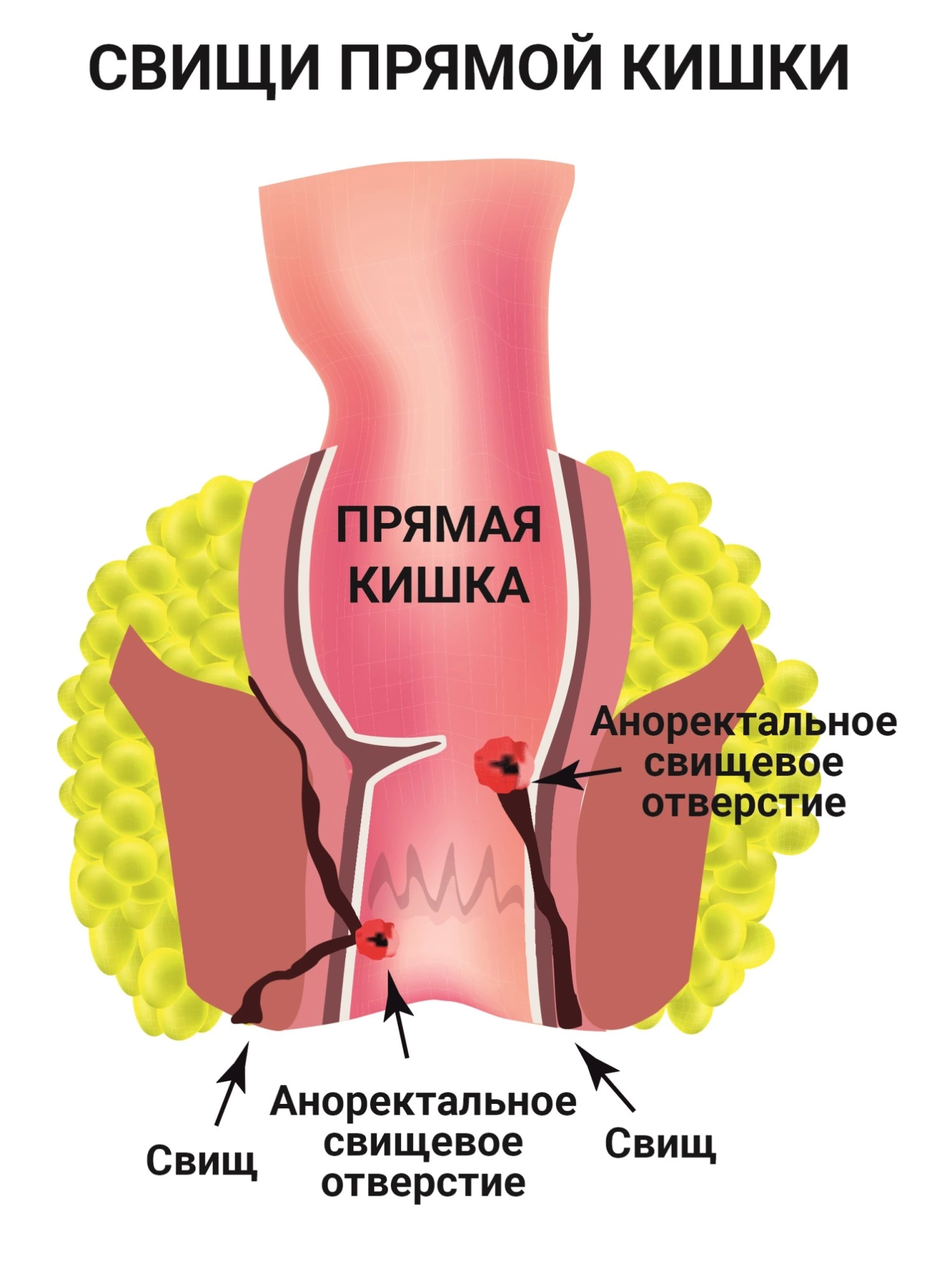 Операция по удалению свища прямой кишки в СПб - сделать иссечение  хронического парапроктита, цены