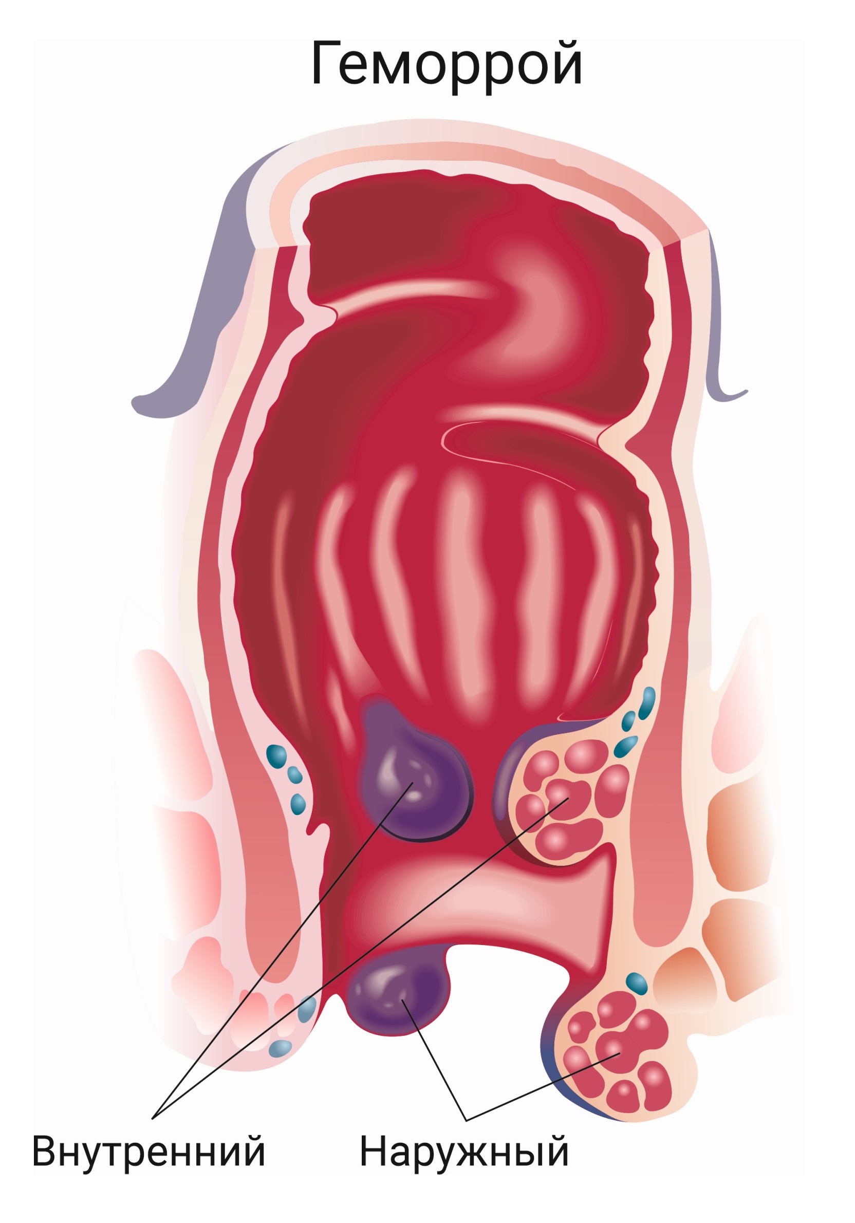 Геморрой вена