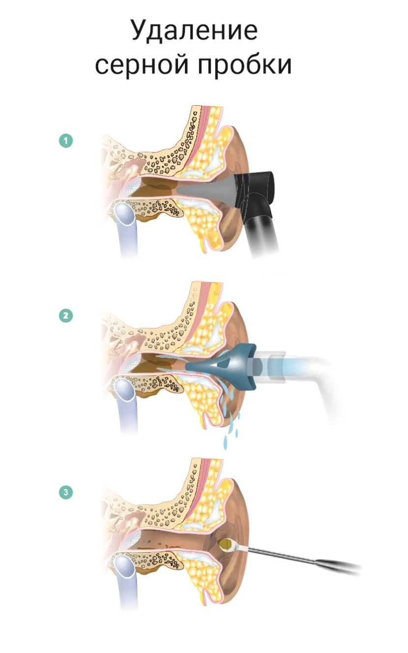 Извлечение серной пробки. Приспособления для удаления серной пробки. Вакуумный удалитель серных пробок. Можно ли промывать уши в домашних условиях