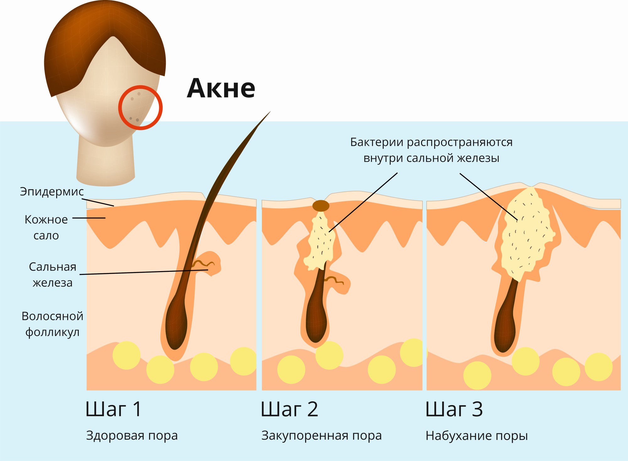 Афазия