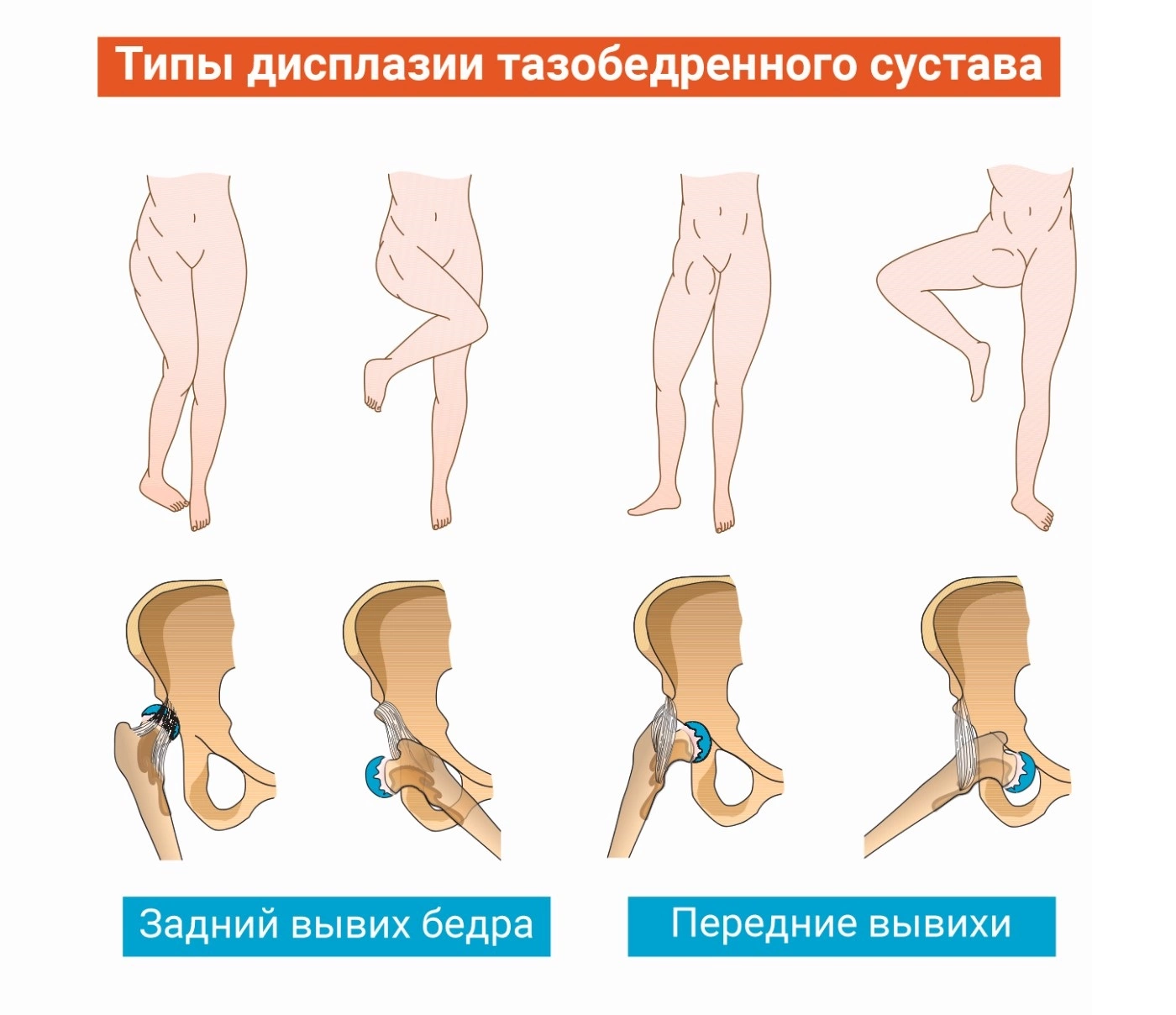 Диагностика дисплазии тазобедренных суставов в клинике Фэнтези