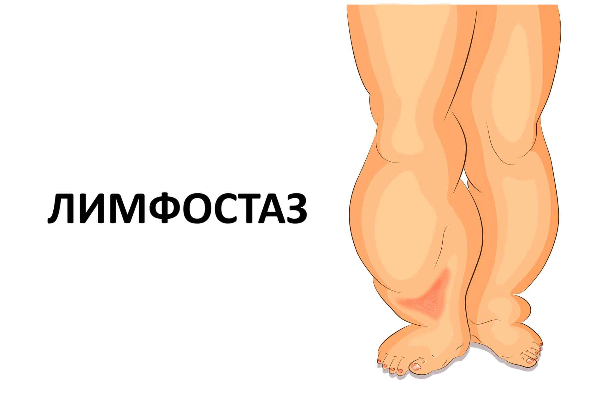 Лимфостаз, или лимфедема