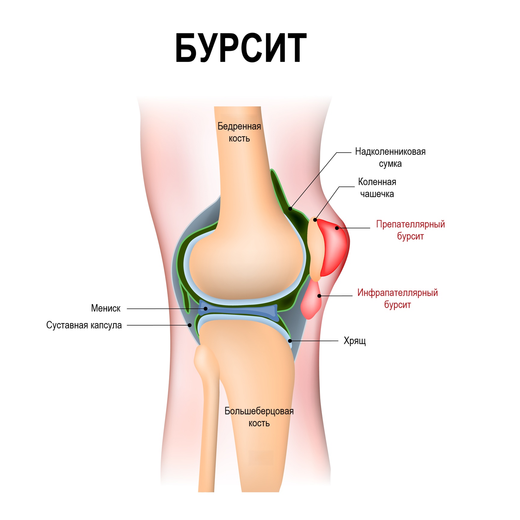Патогенез бурсита Патогенез бурсита
