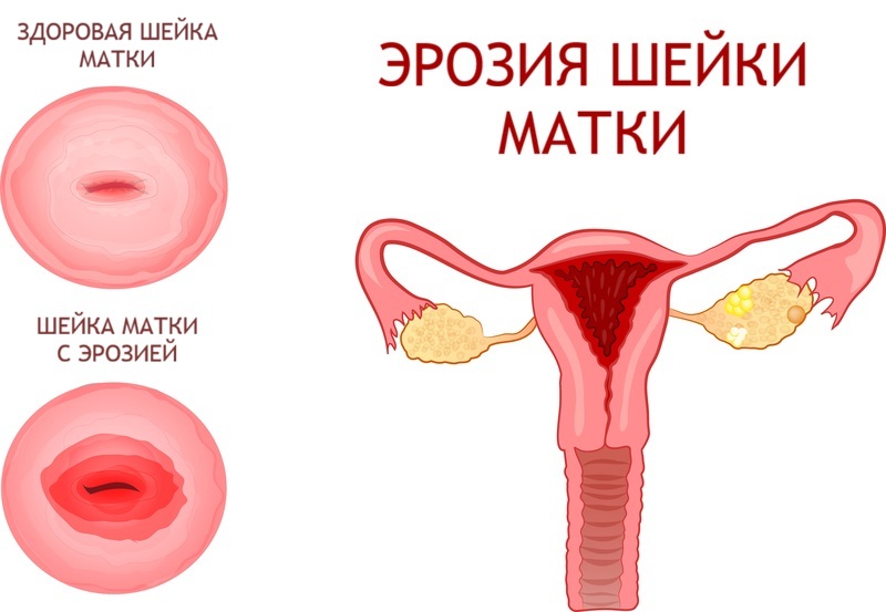 Причинами эрозии Причинами эрозии