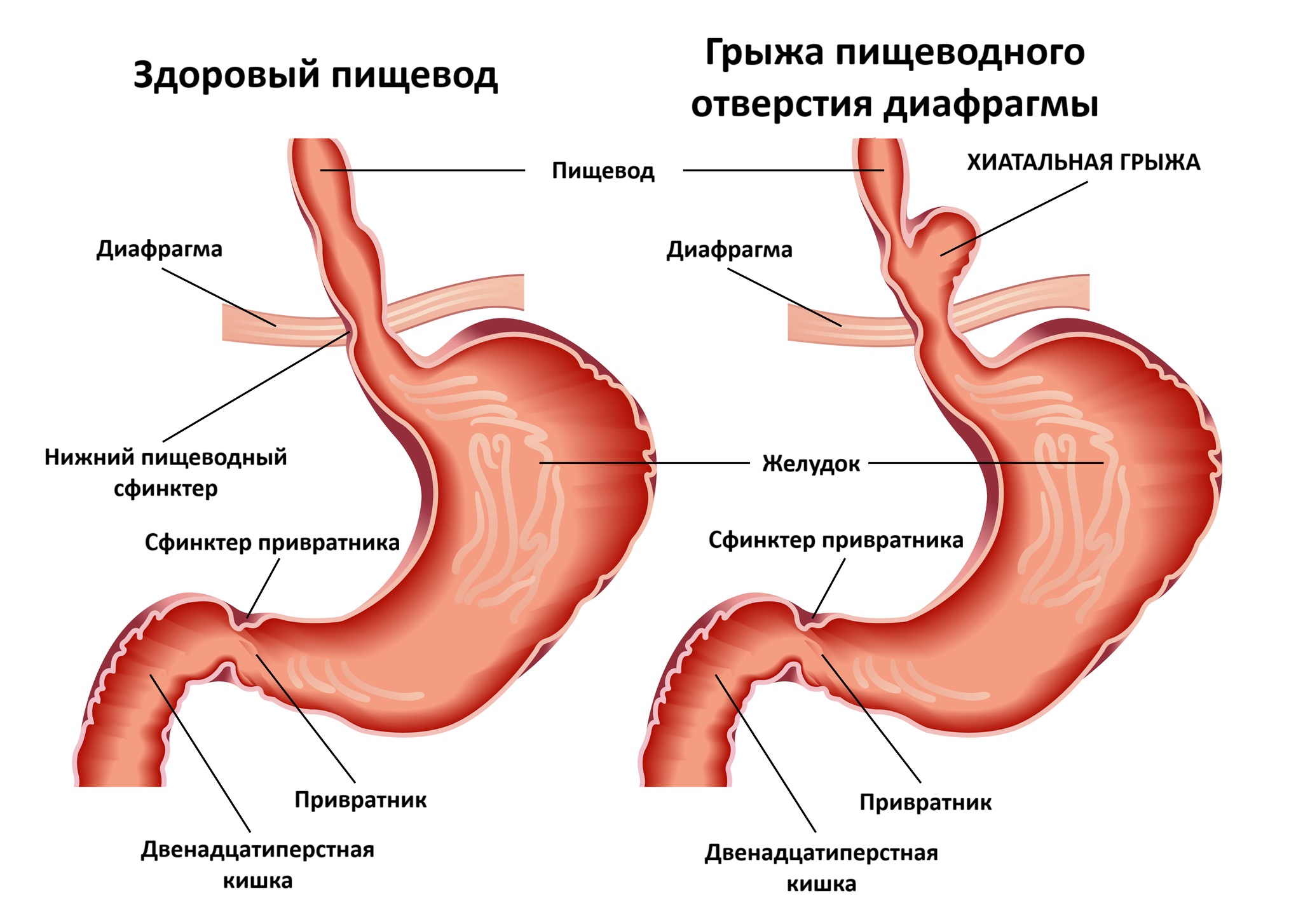 Грыжа пищеводного отверстия диафрагмы