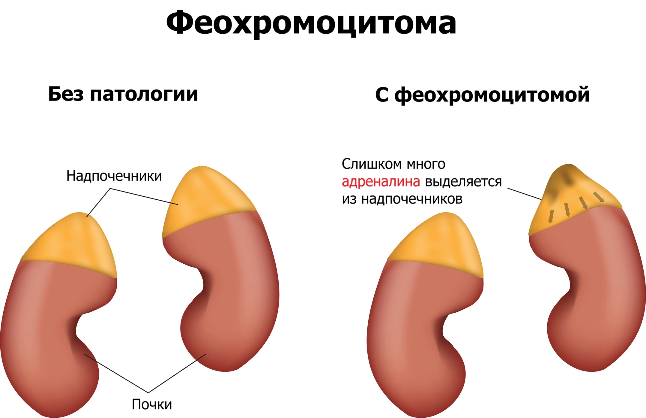 Патогенез