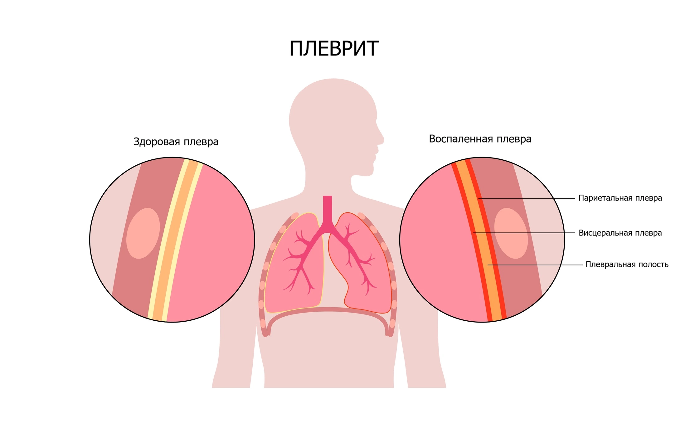 Воспаление плевры