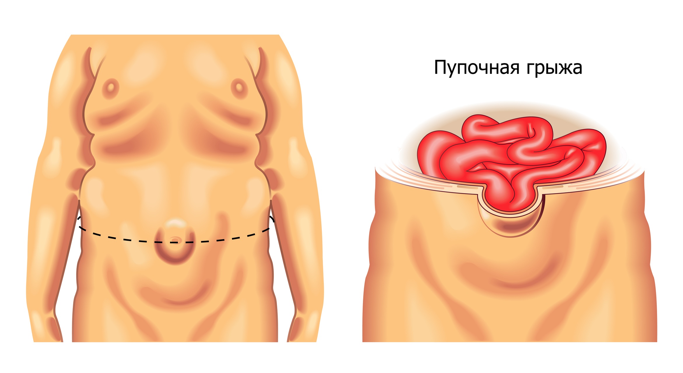 Причина образования грыжи Причина образования грыжи