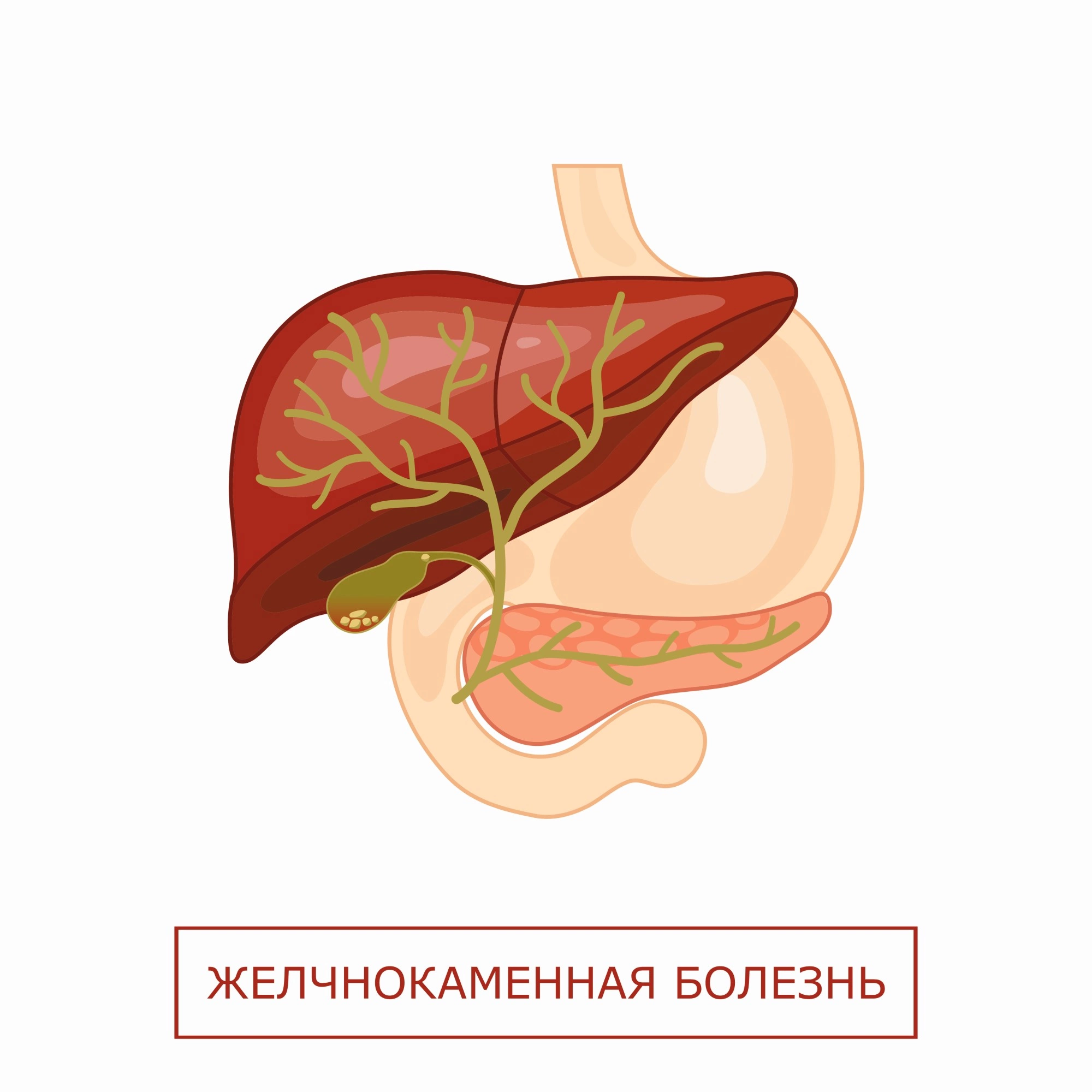 Желчнокаменная болезнь: симптомы и лечение