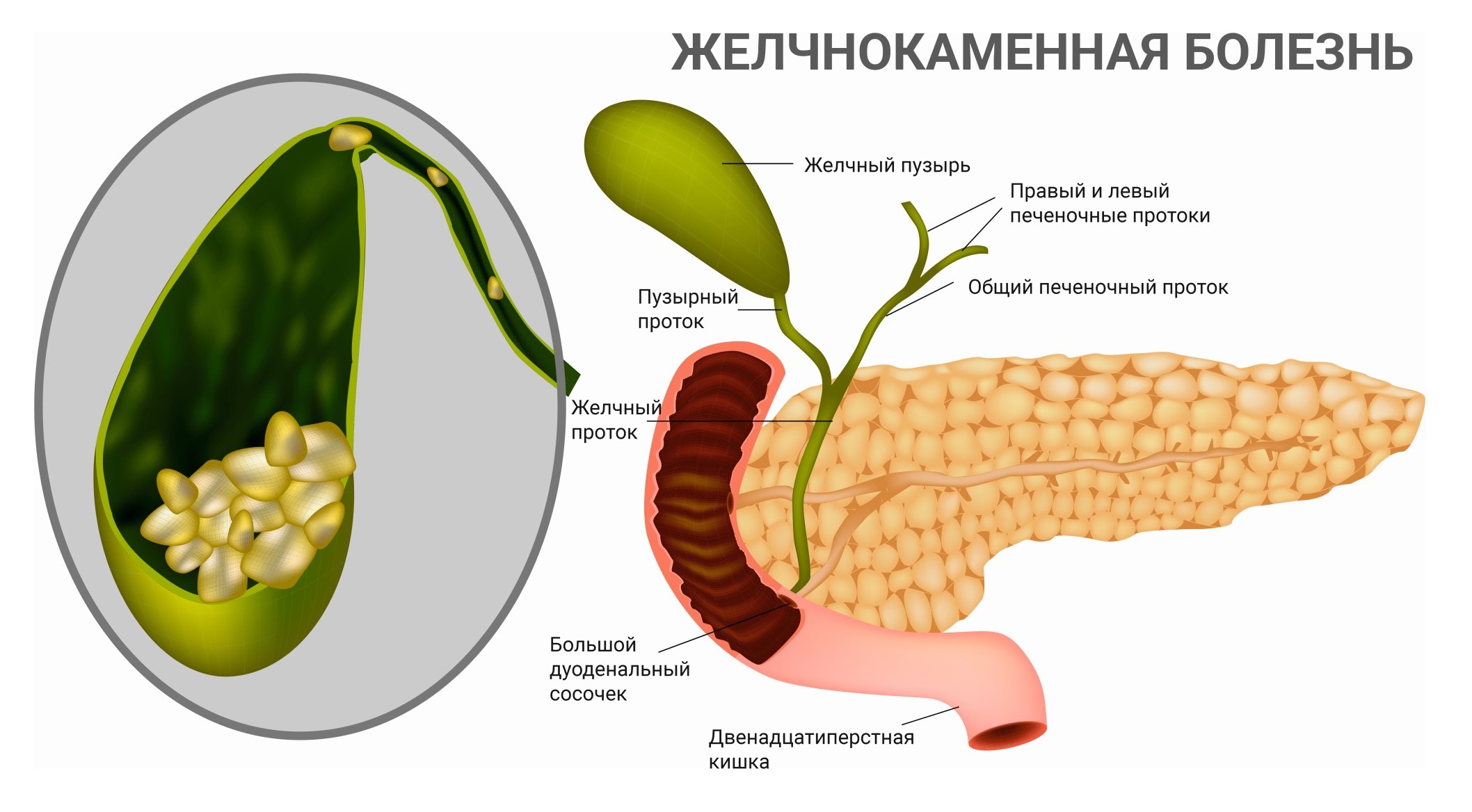 Желчнокаменная болезнь: симптомы и лечение