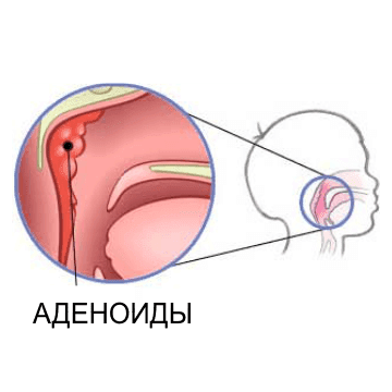 Аденоиды цена