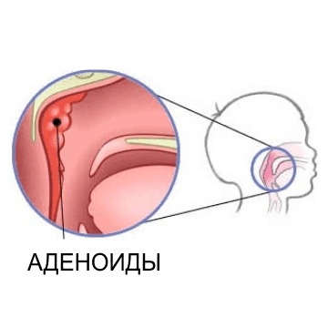 Аденоидные вегетации 1