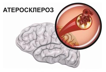 ateroskleroz-sosudov-golovnogo-mozga-d8408839a24b60118fbd6b935c94ed52