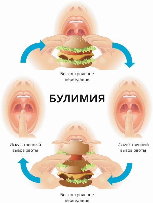 Булимия: симптомы и причины непреодолимой тяги к пище, врач назвала основные симптомы