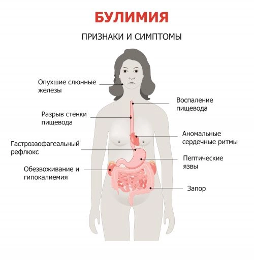 Булимия – это что за болезнь?