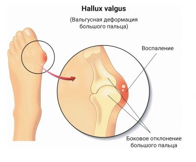 Перелом ноги - причины, виды, симптомы, признаки, диагностика, первая помощь, лечение